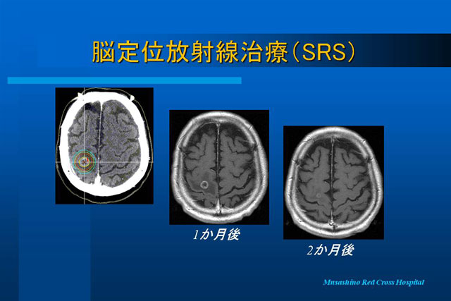 定位放射線治療 SRS
