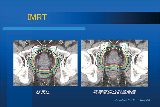 強度変調放射線治療（IMRT）